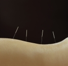 accupuncture2